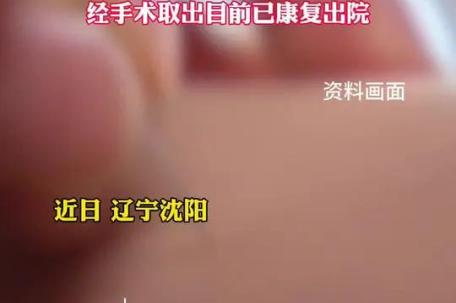 女子自行针灸3针扎入体内游走半月