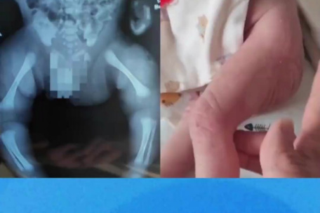 残疾夫妻二胎患先天病 怀疑产检漏检