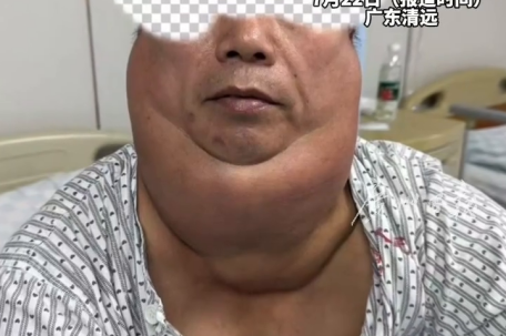 男子每天1斤酒喝出“河马颈”