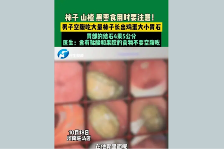 小伙狂炫柿子胃里长出鸡蛋大胃柿石 