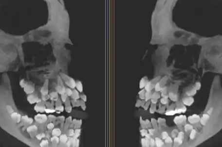 巴西11岁女孩拔牙时发现81颗牙齿