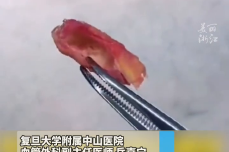 医生展示硬如水泥管的血管完全捏不动