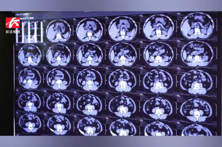 男子长出4cm“生姜”大结石