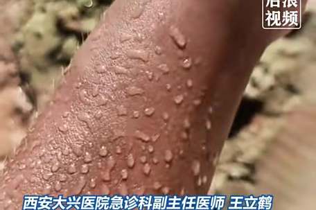 医生：患热射病时内脏像被开水煮